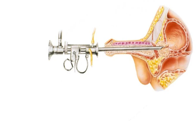 سعر عملية البروستاتا بالليزر